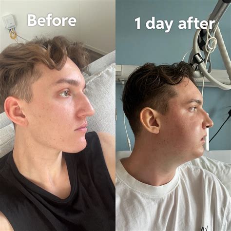 reddit jaw surgery|jaw surgery regret.